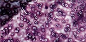 （圖）耶爾森氏菌病