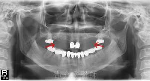先天缺牙 先天缺牙