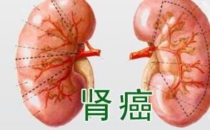 腎癌症狀 腎癌症狀