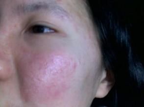 高蛋白過敏 高蛋白過敏