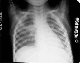 原發綜合徵 原發綜合徵