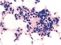 肺組織細胞增生症