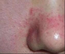 面部蟎蟲 面部蟎蟲