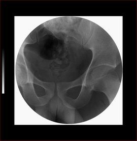 排尿困難 排尿困難