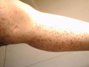 紫癜性扁平苔蘚 紫癜性扁平苔蘚