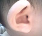 遺傳性耳聾