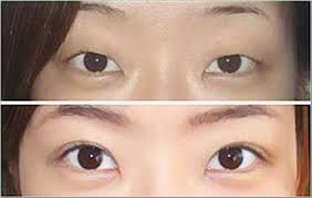 上瞼下垂矯正 上瞼下垂矯正