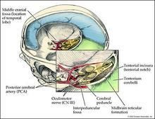 顱內壓增高 顱內壓增高