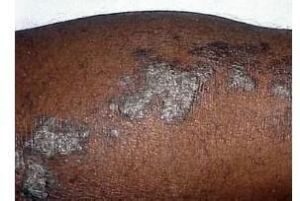 線狀苔蘚 線狀苔蘚