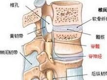 極外側型腰椎間盤突出症