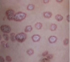 擦爛紅斑 擦爛紅斑