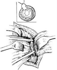 輸尿管切開取石術