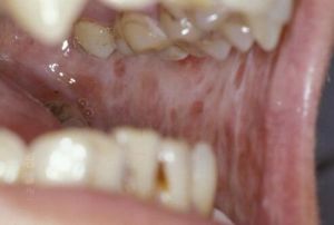 口腔黏膜下纖維化 口腔黏膜下纖維化