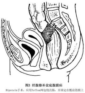盆底腹膜疝 圖3