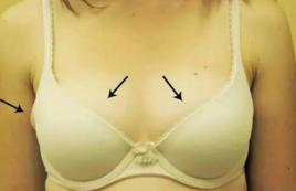 胸型外擴 胸型外擴