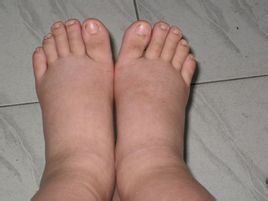 糖尿病腳腫 糖尿病腳腫