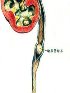 腎、輸尿管結石