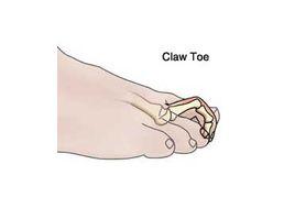 爪形趾 爪形趾