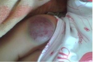 混合型下肢血管瘤