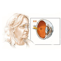 黃斑病變性失明 黃斑病變性失明