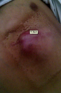 滑膜肉瘤 滑膜肉瘤