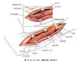 前臂尺橈骨幹骨折切開復位內固定 前臂尺橈骨幹骨折切開復位內固定