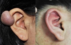 術後診斷結果為痊癒