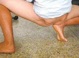 臀肌萎縮 臀肌萎縮