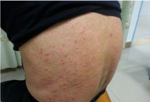 糖尿病性皮疹 糖尿病性皮疹