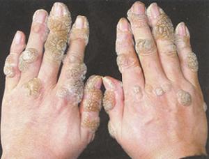 疣狀表皮發育不良