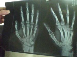 骨折後遺症 骨折後遺症