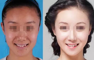 opt雷射嫩膚 opt雷射嫩膚