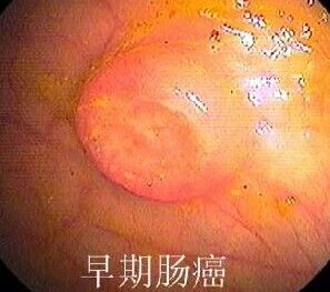 早期腸癌