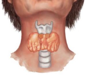 小兒亞急性甲狀腺炎 小兒亞急性甲狀腺炎