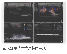超聲表現