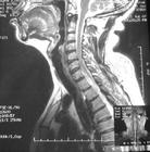 脊髓拴系綜合徵