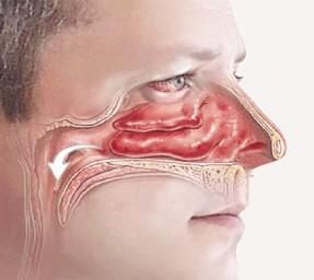 血管運動性鼻炎