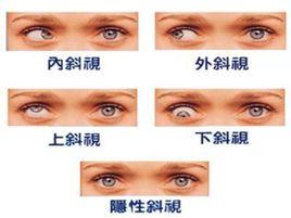 小孩斜視 小孩斜視