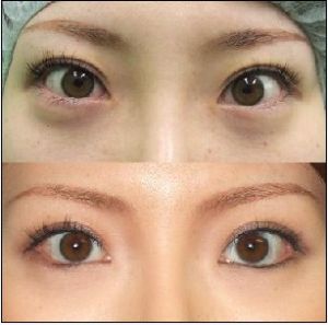 下眼瞼下至術 下眼瞼下至術