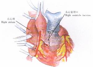 完全性大動脈錯位 完全性大動脈錯位