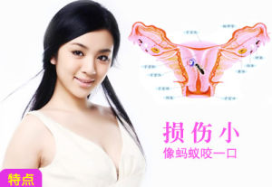 安婷保宮取胚術