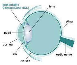 ICL近視植入手術 ICL近視植入手術