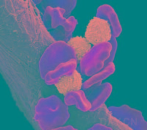 急性髓細胞白血病 急性髓細胞白血病