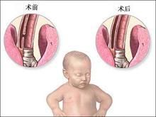 吸入性肺炎 吸入性肺炎