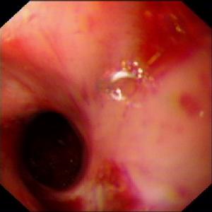 腐蝕性食管灼傷