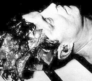 第二顆子彈打掉了他的部分頭蓋骨，使大腦暴露在外