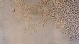 念珠菌性陰炎 念珠菌性陰炎