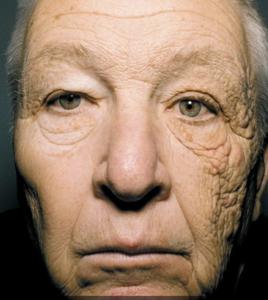 面部老化 面部老化