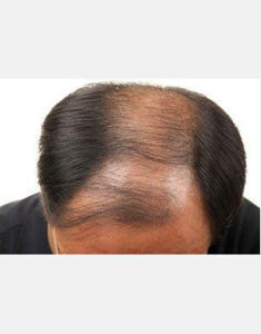 休止期脫髮 休止期脫髮