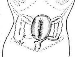 結腸膨脹 結腸膨脹